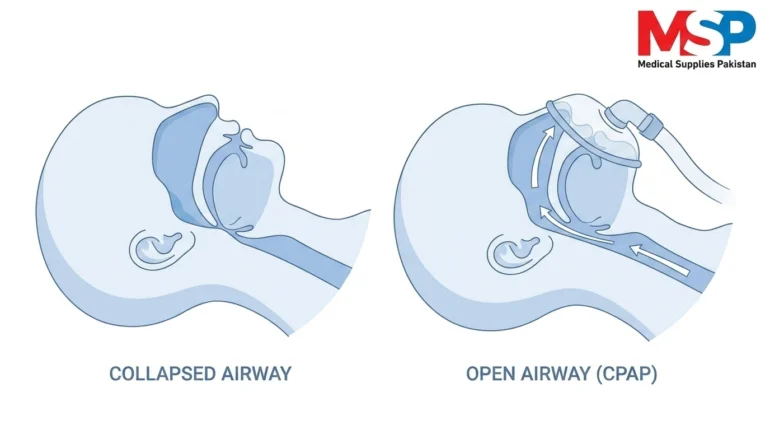 Diagram showing how CPAP air pressure keeps the airway open during sleep